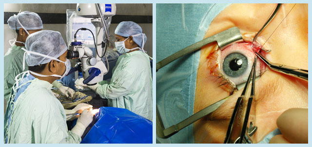 आंखों के ऑपरेशन के दौरान चश्मे का नंबर बढ़ने की चिंता होगी कम